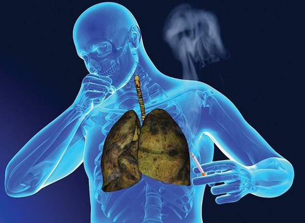 Tức ngực, khó thở là triệu chứng của ung thư phổi